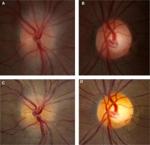 optic neuritis